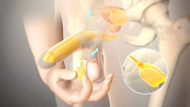 Penile Prosthesis